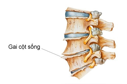 Gai cột sống là một căn bệnh thoái hóa cột sống, hình thành bởi sự phát triển thêm ra của xương trên cột sống
