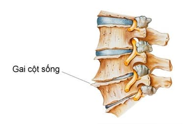 Nguyên nhân gai cột sống và cách phòng ngừa
