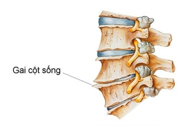 Nguyên nhân gai cột sống và cách phòng ngừa