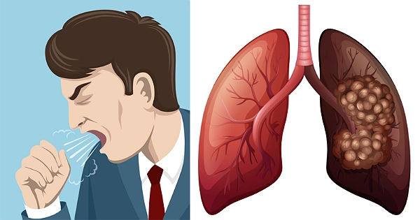 Các biểu hiện bệnh ung thư phổi thường chỉ xuất hiện ở giai đoạn muộn