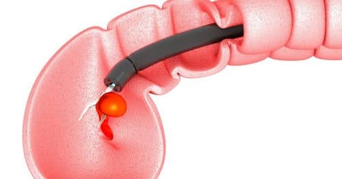 Cắt polyp trực tràng thường được thực hiện trong quá trình nội soi trực tràng.