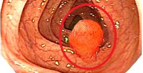 Polyp trực tràng không chỉ đem đến nhiều phiến toái, làm giảm chất lượng cuộc sống mà còn có thể biến chứng thành ung thư đe dọa đến tính mạng của người bệnh.