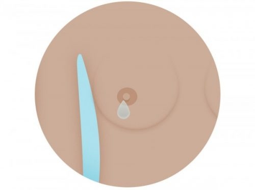 Chảy dịch núm vú xuất hiện ở nhiều bệnh nhân ung thư vú