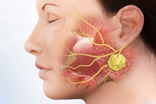 Dấu hiệu của bệnh ung thư tuyến nước bọt bạn không nên bỏ qua