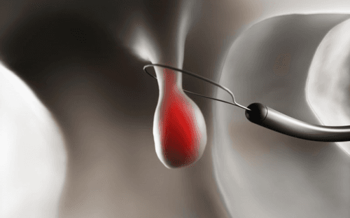 Việc cắt polyp trực tràng thường được tiến hành trong quá trình nội soi.