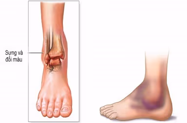 Sai lầm khi xử trí bong gân, trật khớp khiến bệnh nặng thêm