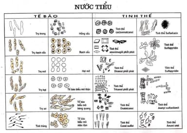 Xét nghiệm bạch cầu trong nước tiểu dương tính nghĩa là gì?