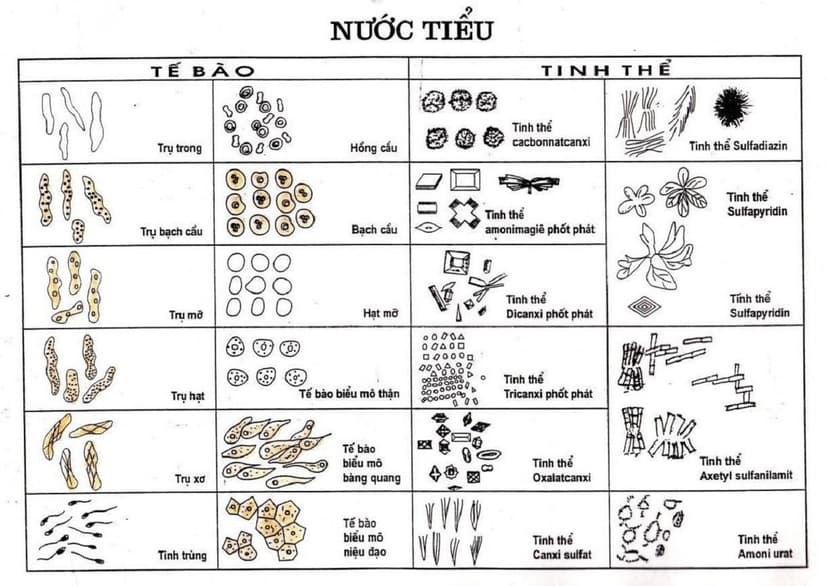 Xét nghiệm bạch cầu trong nước tiểu dương tính nghĩa là gì?