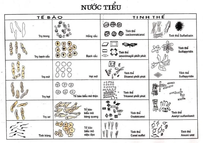 Xét nghiệm bạch cầu trong nước tiểu dương tính nghĩa là gì?