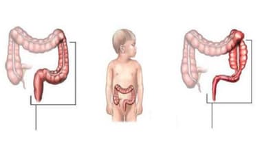 Mổ phình đại tràng bẩm sinh tử vong do không được điều trị