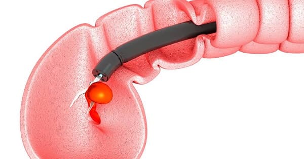 Với những polyp trực tràng có kích thước lớn hoặc nghi ngờ ác tính thì cần cắt bỏ để ngăn ngừa ung thư