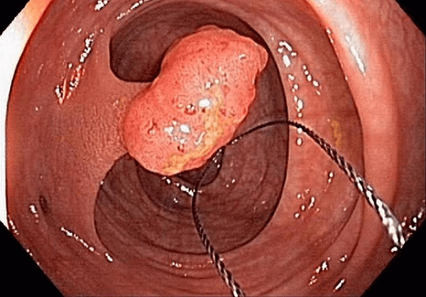 Polyp trực tràng là sự tăng sinh quá mức của thành niêm mạc hậu môn trực tràng khiến cho chúng hình thành các khối u nhỏ hình elip hoặc hình tròn trong lòng ruột.