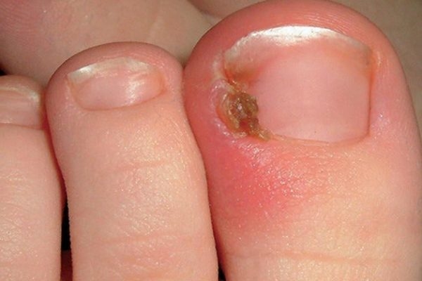 Lấy khóe móng chân bị chọc thịt phải làm gì?