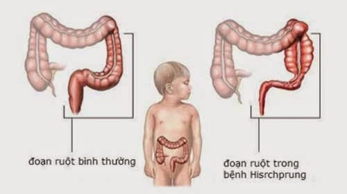 Mổ phình đại tràng bẩm sinh cần thiết sau khi có chẩn đoán chính xác trẻ đã mắc bệnh.