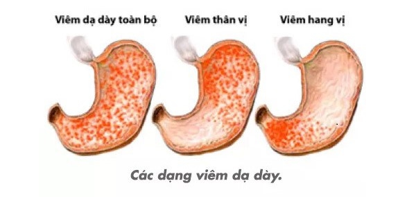 nguyen-nhan-trieu-chung-viem-hang-vi-da-day-1