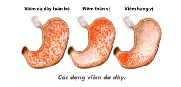 Nguyên nhân, triệu chứng viêm sung huyết hang vị dạ dày