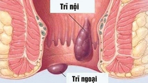 Bệnh trĩ là tình trạng giãn quá mức đám tĩnh mạch ở vùng hậu môn- trực tràng.