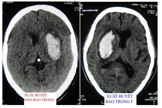 xuất huyết não