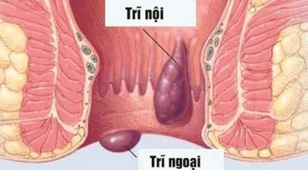 Trong số các cách điều trị bệnh trĩ hiện nay, phương pháp thắt mạch búi trĩ dưới hướng dẫn của siêu âm doppler gọi tắt là phẫu thuật DGHAL-RAR đã và đang được ứng dụng rộng rãi tại nhiều nước Châu Âu.