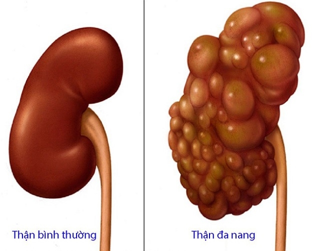 Siêu âm có biết suy thận không - Thận đa nang