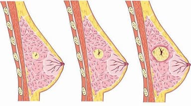 U nang vú có chuyển thành ung thư không?