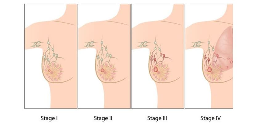 Có khối u ở vú có phải là ung thư vú không?