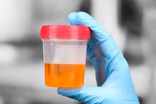 Chỉ số LEU 500 trong nước tiểu là gì và có ý nghĩa gì