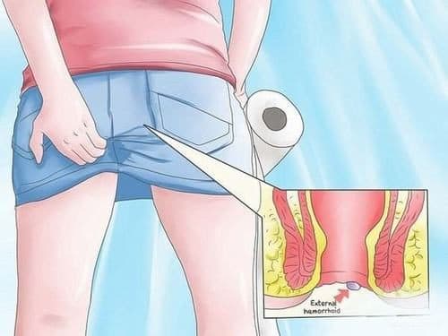 Ung thư hậu môn có thể gây ra nhiều triệu chứng nhưng hình ảnh ung thư hậu môn dễ nhận biết nhất là u cục ở hậu môn.