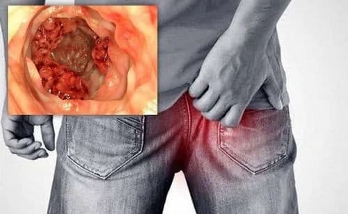 Ung thư hậu môn có thể được kiểm soát và chữa khỏi
