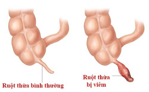 lam-the-nao-de-nhan-biet-viem-ruot-thua-cap-o-tre-em-1