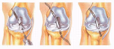 Tìm hiểu về mổ đứt dây chằng đầu gối