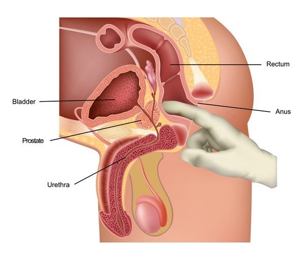 Tầm soát ung thư tuyến tiền liệt ở đâu