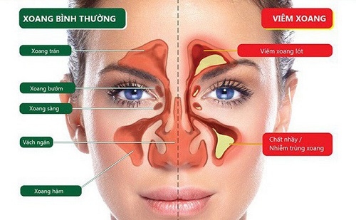 Ngạt tắc mũi do viêm xoang rất phổ biến