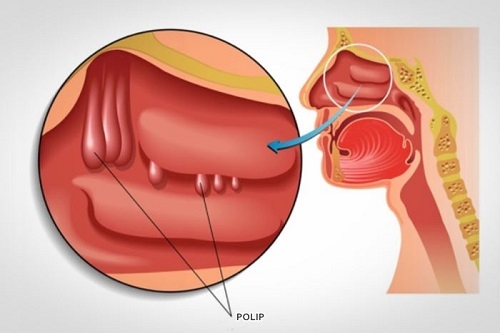 ngạt mũi lâu ngày là dấu hiệu của bệnh gì