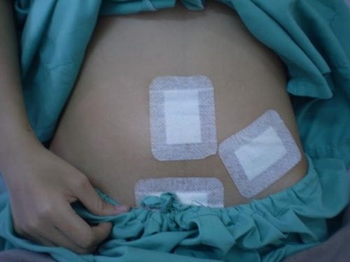 uu-diem-viem-ruot-thua-mo-noi-soi-3