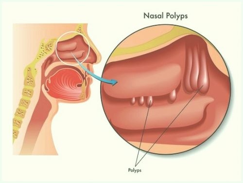Polyp mũi là bệnh lý mũi xoang phổ biến