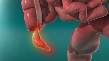 Thời gian của ca mổ ruột thừa và các phương pháp