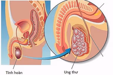 3 bệnh ung thư chỉ nam giới mới mắc
