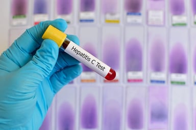 Anti HCV nonreactive là gì? Ý nghĩa của chỉ số