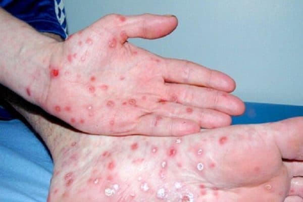 Phòng khám da liễu Thu Cúc khám và điều trị bệnh giang mai hiệu quả