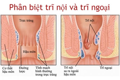 Phòng khám Thu Cúc có khám và cắt trĩ không - Phân biệt trĩ nội và trĩ ngoại