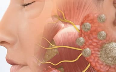 Dấu hiệu ung thư tuyến nước bọt bạn đừng nên chủ quan