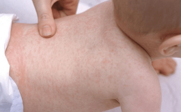 Sốt phát ban do nhiều loại virus khác nhau gây ra và thường gặp ở trẻ nhỏ mùa nắng nóng, vì vậy ba mẹ cần nhận biết sớm và nên đưa trẻ đi thăm khám kịp thời.