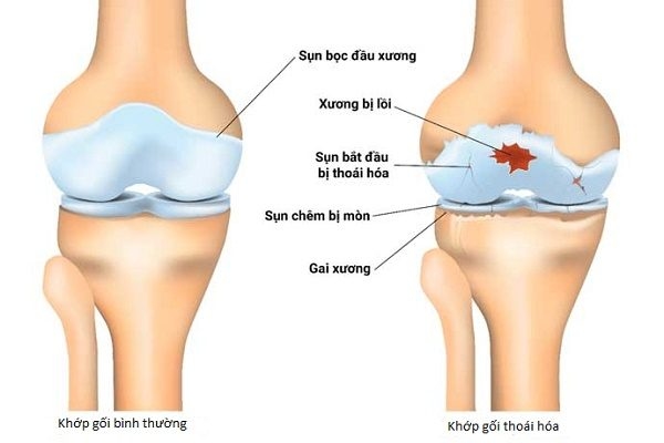 Thoái hóa khớp gối
