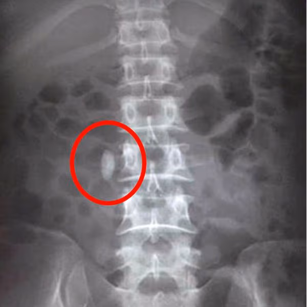 Hình ảnh sỏi niệu quản khi chụp x quang thận thường.