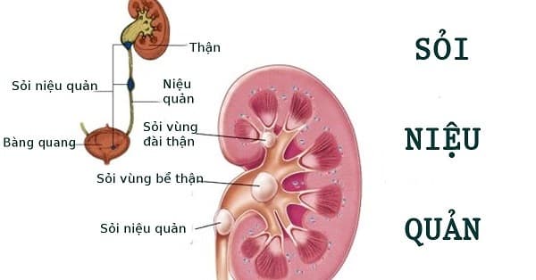 Hình ảnh mô tả sỏi niệu quản trong hệ tiết niệu