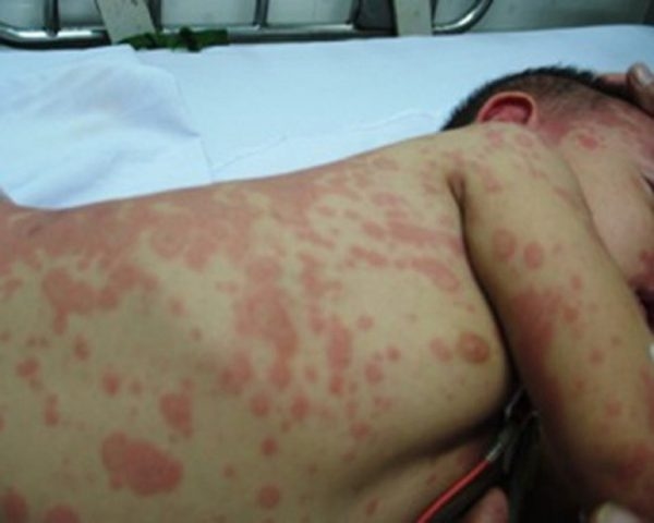 Xuất huyết giảm tiểu cầu ở trẻ em có các biểu hiện như da bị xuất huyết có chấm nhỏ li ti như muỗi đốt