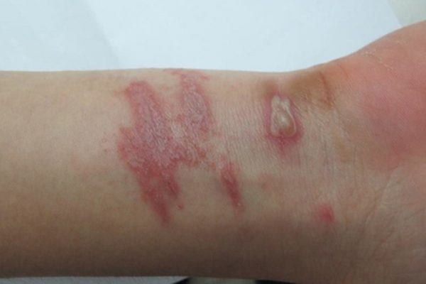 Biểu hiện viêm da khi bị kiến ba khoang đốt