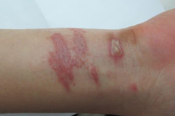 Biểu hiện viêm da khi bị kiến ba khoang đốt