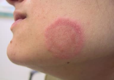 Dấu hiệu của bệnh hắc lào tăng mức độ tổn thương trên da